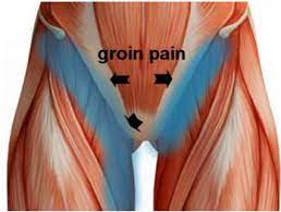 Groin pain is discomfort that happens where the inside of your upper thigh and your abdomen come together. What Is Your Groin Pain Rhp Physiotherapy