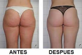 Como Eliminar La Celulitis De Las Piernas Y Gluteos Rapidamente Video Como Quitar La Celulitis En Piernas Y Gluteos Con Ejercicios Multidimensionales Symulast Como Celulitis Piernas Como Quitar La Celulitis Pierna Y Gluteo