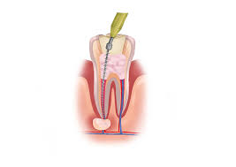 Will dental insurance cover any costs of inplants. Root Canal Cost Treatment And Recovery Authority Dental