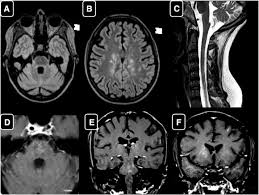 Alibaba.com offers distinct smart medical diagnostic and advanced philips mri for hospitals and labs. Clippers Like Mri Findings In A Patient With Multiple Sclerosis Journal Of The Neurological Sciences