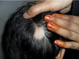 Alopecia areata: well defined circumscribed patch of hair loss ...
