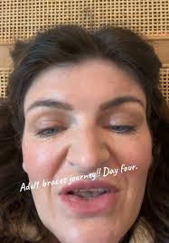 braces #orthodontist #orthodontics #orthodontistappointment