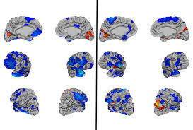 However, they tend to play, learn, speak, and. Large Set Of Brain Scans Reveals No Telltale Signs Of Autism Spectrum Autism Research News