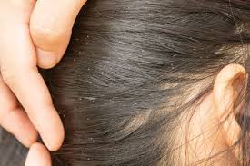 Take the bag outside, and shake out the enclosed item. Head Lice Pictures What Does A Lice Bite Look Like