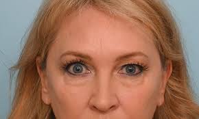 Blepharoplasty Before & After Photos