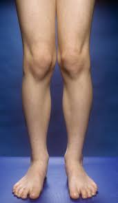 M3500327 Knock Knees Spl 174x300 Jpg 3025 5216 Knock Knees Knock Knees Exercises Knee Exercises