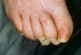 Image result for Onychogryphosis feet