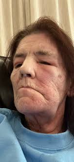 Steroid shots in Texas for severe allergies