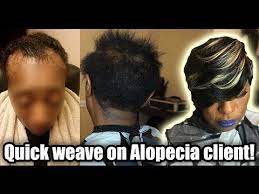 How To Quick Weave On A Client With Alopecia Youtube Quick Weave Quick Weave Hairstyles Short Weave Hairstyles