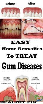 Home Remedies For Gum Disease Gum Disease Remedies Gum Disease Gum Disease Treatment