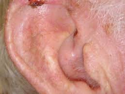 If you know what to look for, you can spot warning signs of skin cancer early. Squamous Cell Carcinoma Of The Ear Images Dermnet Nz