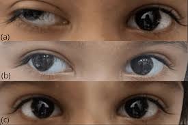 Image result for Eye Deviation