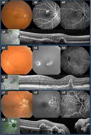 The Spectrum Of Polypoidal Choroidal Vasculopathy In Caucasians Clinical Characteristics And Proposal Of A Classification Springerlink