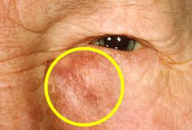 Retinoblastomas nearly always occur in young children. Visual Guide To Eye Cancers