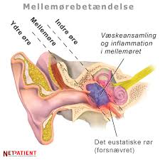 Har en stund hatt følelsen av væske i væske i mellomøret er en tilstand der mellomøret, som normalt er luftfylt, er fylt. Mellemorebetaendelse Voksen Barn Baby Symptomer Smitte Osv