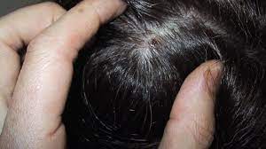Are You Constantly Scratching Your Head If The Answer Is Yes You Might Have Scabs On Scalp These Scabs Are Rai Dry Scalp Dandruff Vs Dry Scalp Dry Hair Care