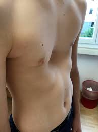 Image result for Pectus Excavatum