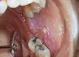 It can be tough to find throat cancer in its early phases. Oral Cancer Images The Oral Cancer Foundation