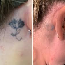 At removery in richmond, va, our laser specialists use a picoway laser to safely remove or fade your tattoo. Facebook