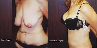 Commitment to making these changes is often required before a surgeon will perform the. Total Body Makeover After Gastric Bypass Surgery Beverly Hills Dr Stuart A Linder