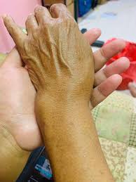 Tidak semua kasus patah tulang diperlukan tindakan operasi dan pasang penbeberapa kasus dapat diterapi dengan konsep imobilisasi dgn gips, tp tentu tidak sem. Menyedihkan Meski Tangan Patah Ibu Ini Rela Masak Di Hari Raya Namun Tak Ada Kerabat Yang Datang Semua Halaman Suar