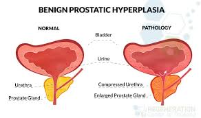 Immunotherapy Stem Cells For Treating Prostate Cancer