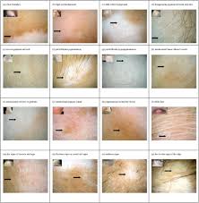 Image result for Postinflammatory Hypopigmentation