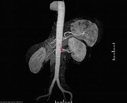 Start studying renal blood flow. Renovaskulare Hypertonie Herz Kreislauf Krankheiten Msd Manual Profi Ausgabe