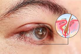 Image result for demodex rosacea