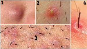 Because shaving cuts your hair at the skin, it creates the perfect opportunity for newly shortened hairs to curl back into the skin and create an ingrown hair. Home Remedies To Get Rid Of Painful Ingrow Hair And Razor Bumps Ingrown Hair Cyst Ingrown Hair Ingrown Hair Bump