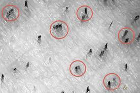 Pili multigemini is a malformation characterized by the presence of bifurcated or multiple divided hair matrices and papillae, giving rise to the formation of multiple hair shafts within the individual follicles.:768. Problem Area At 50x Badger Blade