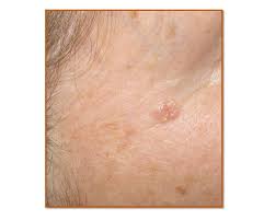 17.08.2015 · the first sign of skin cancer is formation of small bumps on your head or development of scaly rough patches on the scalp. Actinic Keratosis And Squamous Cell Carcinoma Photodamage In Progress