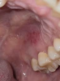 Image result for Canker sores symptoms roof of the mouth