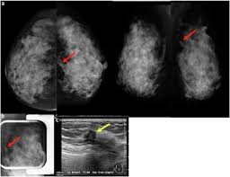 Image result for Mammogram Interpretation