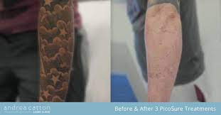 Lower Arm Tattoo Before And After Three Picosure Laser Treatments Tattooremoval Tattoos Inke Diy Tattoo Permanent Lower Arm Tattoos Picosure Tattoo Removal