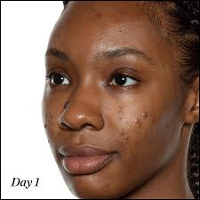 How do you get rid of forehead acne? Acne Sunday Riley