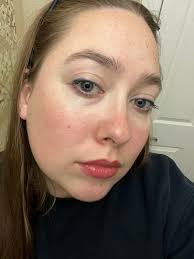 Hi I have a question…. So I have had episodes of flushing. My eyes will  turn red and my face and ears will turn red and get hot. I will get a