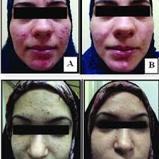 PDF) Topical erythromycin-zinc acetate complex lotion versus topical  erythromycin gel in treatment of mild to moderate acne vulgaris