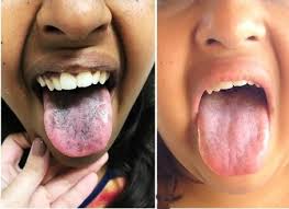 Image result for brown tongue symptoms