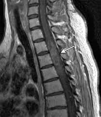 Protein backbone is what holds a protein together and gives it an overall shape (or tertiary structure). Diagnostic Approach To Intrinsic Abnormality Of Spinal Cord Signal Intensity Radiographics