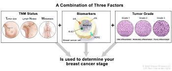 Image result for Breast Cancer Staging