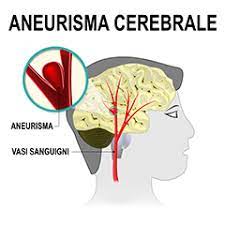 In alcuni casi, tuttavia, un grand'aneurisma o che stanno stampando contro i determinati nervi o tessuti può. Aneurisma Cerebrale Vero Falso Dissecante Issalute