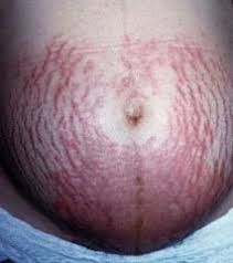 Cara mengobati kulit kering gatal dan bersisik. Kegatalan Kulit Semasa Hamil Dr Zubaidi Hj Ahmad Menulis