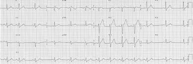 L'aritmia sinusale è un'alterazione del ritmo cardiaco dovuta a problemi di automatismo/conduzione o a cause fisiologiche. Simulazione 1 Caso 126