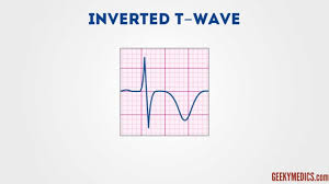 How To Read An Ecg Ecg Interpretation Geeky Medics