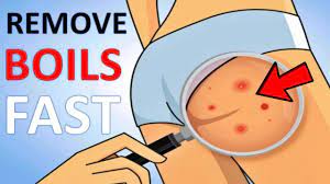 How to Get Rid of Boils on the Buttocks? | 14 Home Remedies for Boils -  YouTube