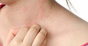 Image result for Hives