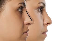 Hier entsteht eine neue webseite! Nasenoperation Rhinoplastik Antiagingnews Net