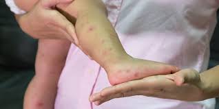 Semakin cepat tindakan pengobatan yang kita ambil maka akan lebih baik sebelum cacar menjadi lebih banyak lagi muncul. Cacar Air Pada Bayi Gejala Obat Dan Pencegahan