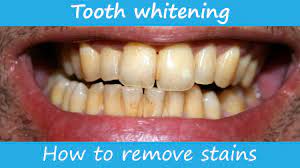 Hydrogen peroxide can be used to remove stain on teeth. How To Remove Stains From The Teeth Youtube